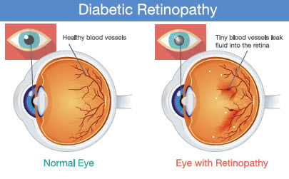 Diabetic Retinopathy | Hormone Health Network